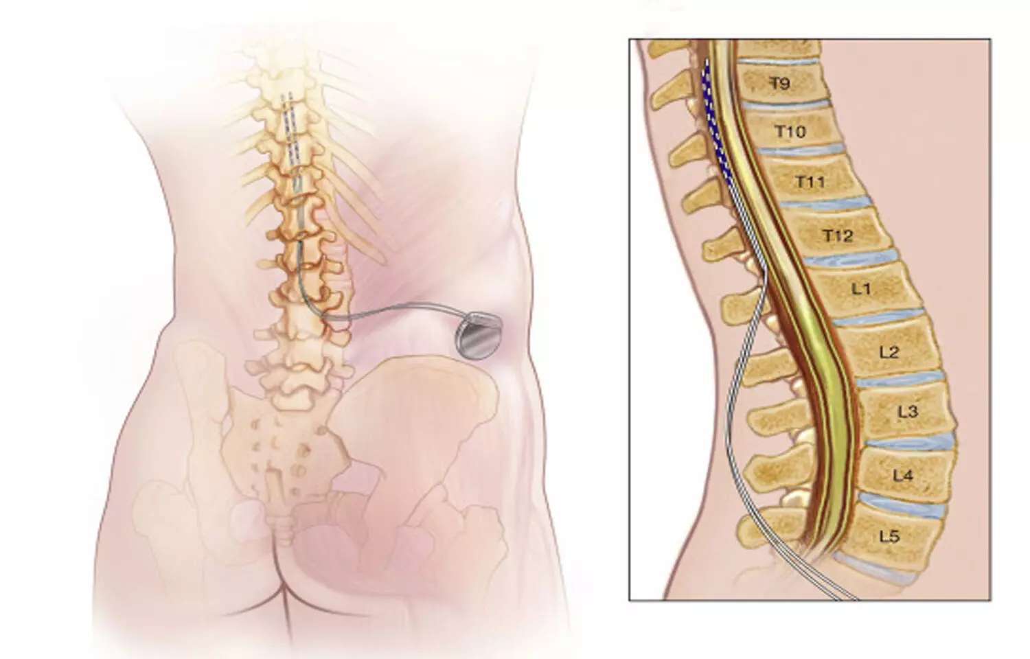 Sacral erector spinae plane block effective for pain relief after pilonidal sinus surgery: Study Sacral erector spinae plane block effective for pain relief after pilonidal sinus surgery: Study