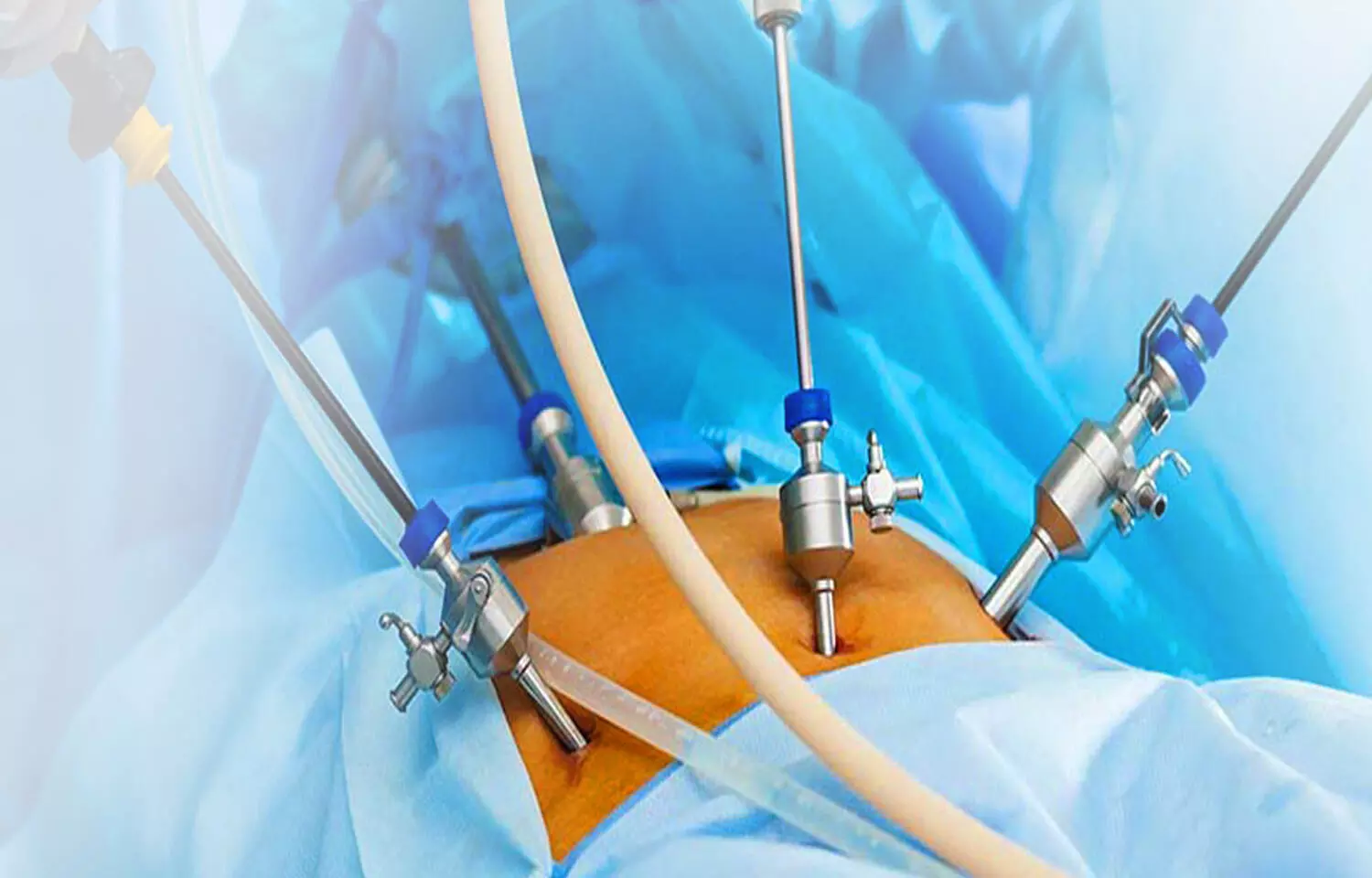 Remimazolam with Estazolam Combination Reduces Pain After Laparoscopic Surgery: Study Remimazolam with Estazolam Combination Reduces Pain After Laparoscopic Surgery: Study