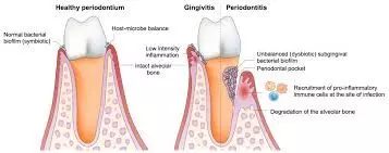 Tooth loss linked to increased risk of all-cause, CVD-related and diabetes related mortality: Study Tooth loss linked to increased risk of all-cause, CVD-related and diabetes related mortality: Study